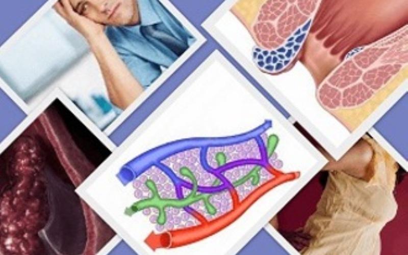 флебодиа 600 отзывы при геморрое