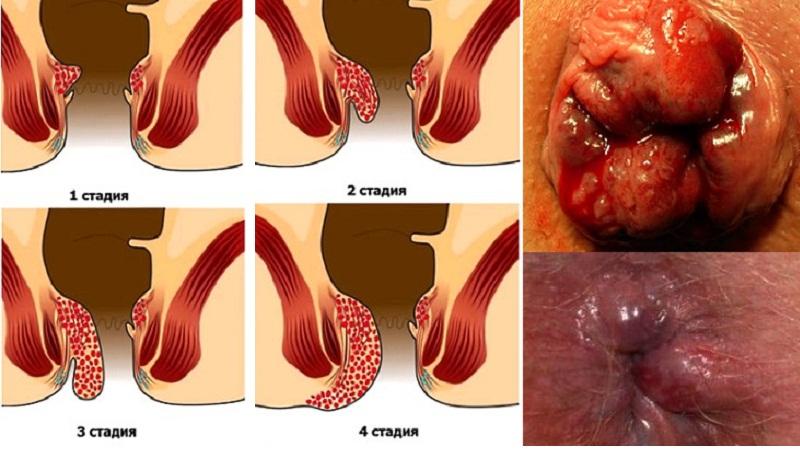 флебодиа отзывы при геморрое отзывы
