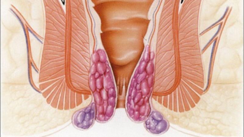 гель лиотон при геморрое отзывы