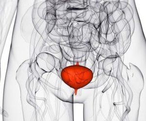 Что такое геморроидальный цистит и как его лечить