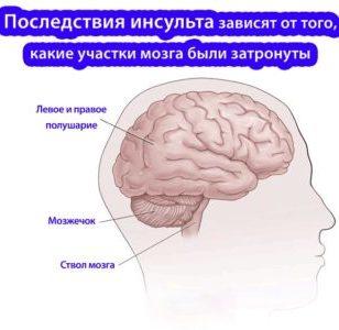 геморроидальный инсульт головного мозга что это такое