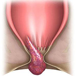 геморроидальные шишки лечение народными средствами