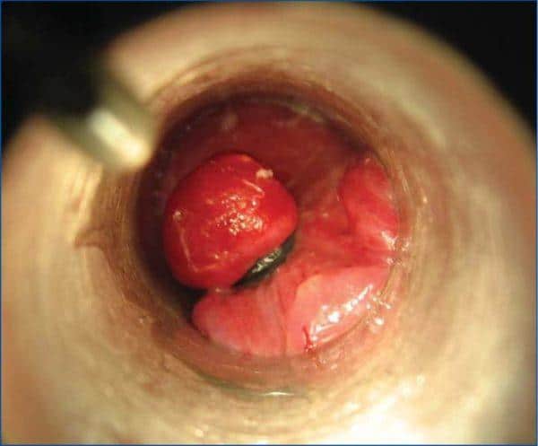 геморрой шишка наружная чем лечить