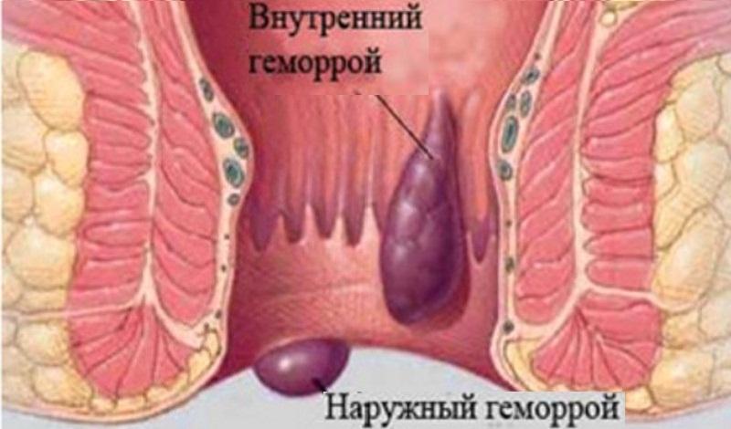 геморрой как лечить наружный