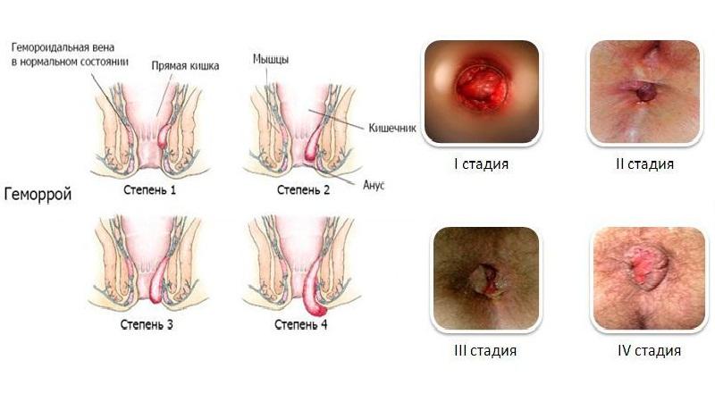 наружный геморрой чем лечить