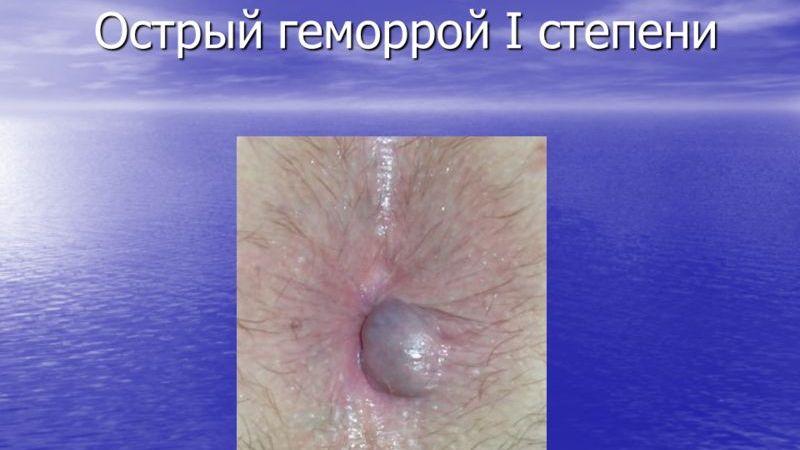 геморрой как вылечить народными средствами