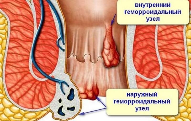 народное средство от геморроя эффективное
