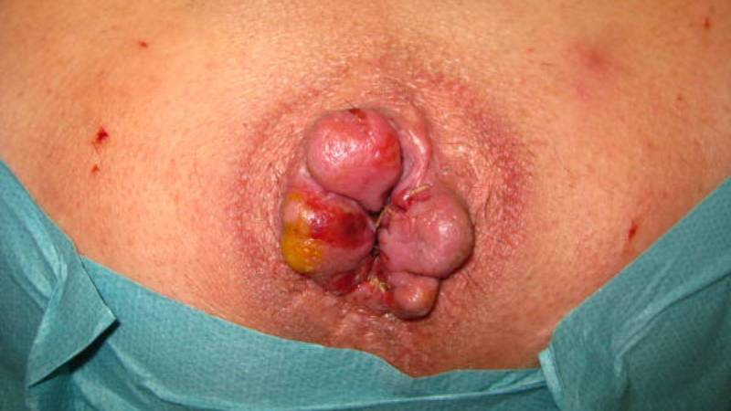 к какому обратиться врачу при геморрое к какому врачу с геморроем обращаться