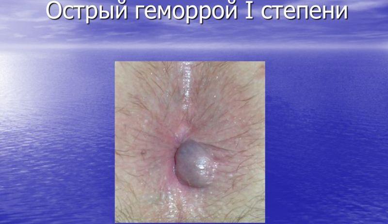 геморрой у ребенка фото