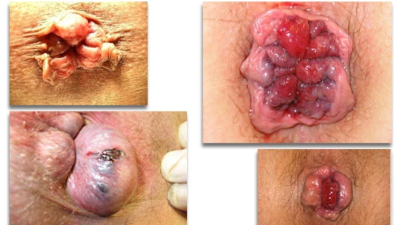 признаки геморроя у детей