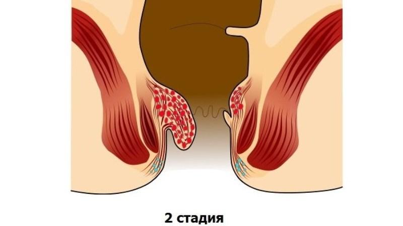 как без операции вылечить геморрой