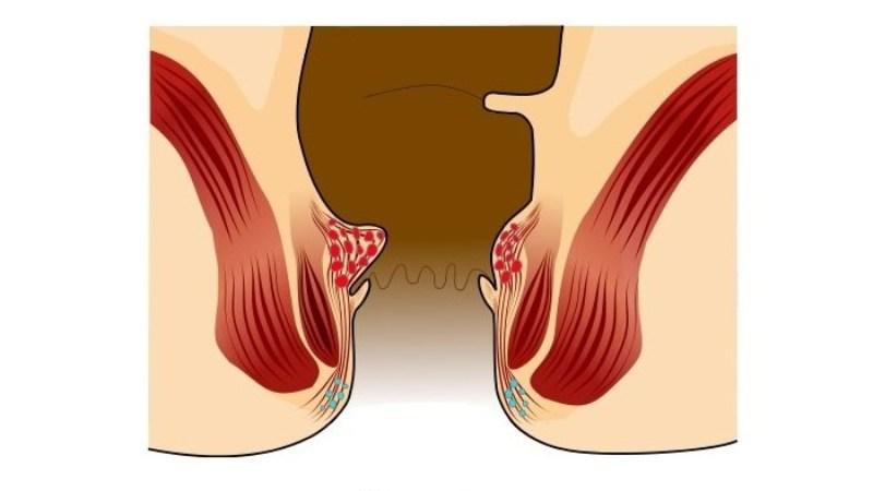 геморрой начальная стадия у женщин фото