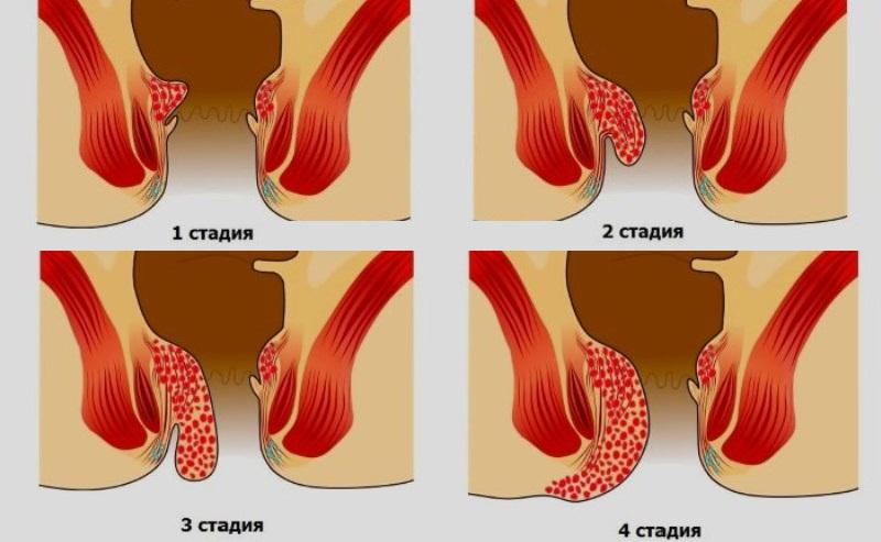 как выглядит геморрой у мужчин начальная стадия лечение фото