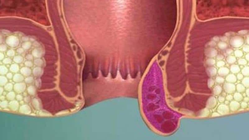 геморрой фото 1 стадия фото