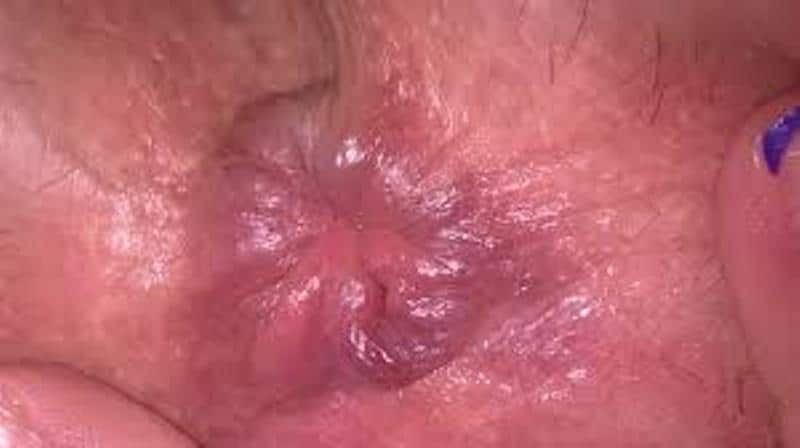 первая стадия геморроя у женщин фото