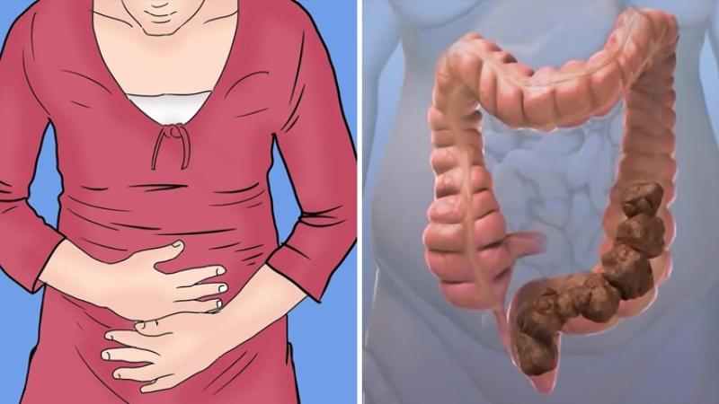 образование запора после кесарева сечения