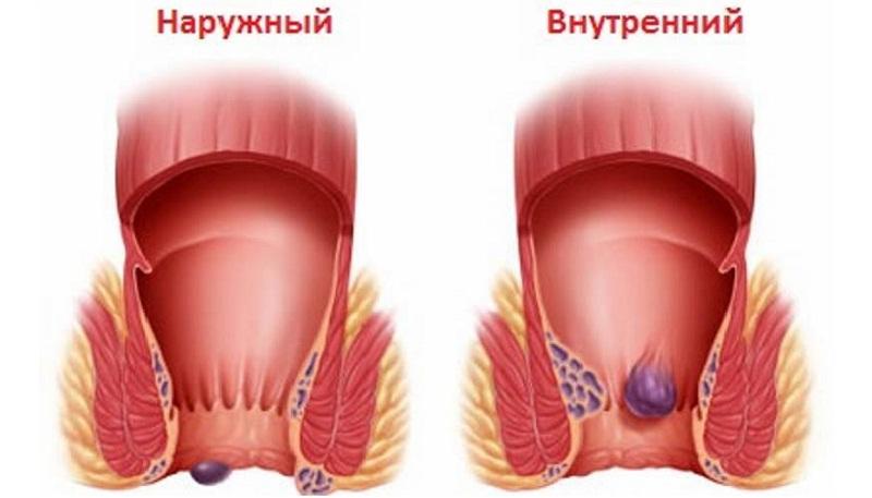 как лечить геморрой