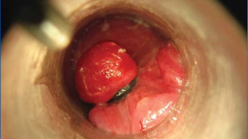 Причины геморроя после кесарева сечения