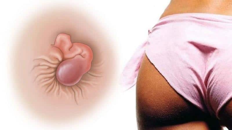 Что вызывает запор после кесарева сечения