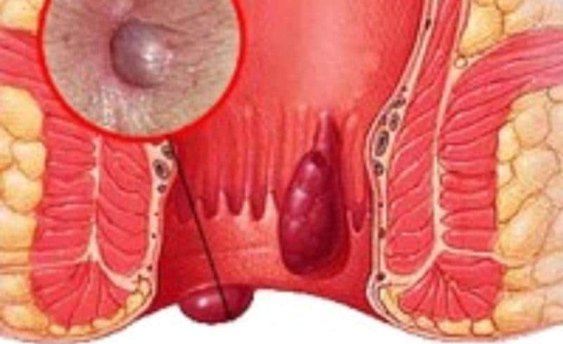 геморрой при беременности чем лечить