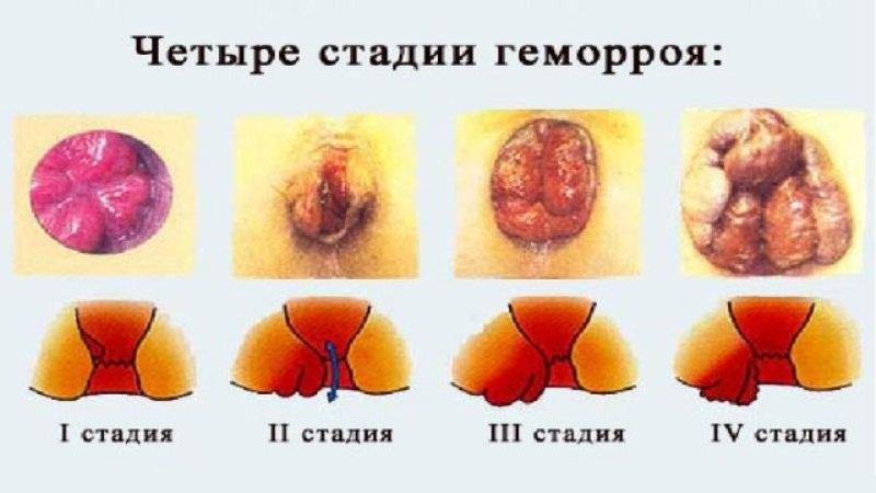 геморрой во время беременности