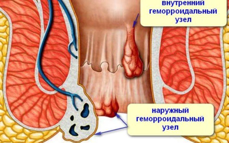 профилактика геморроя во время беременности