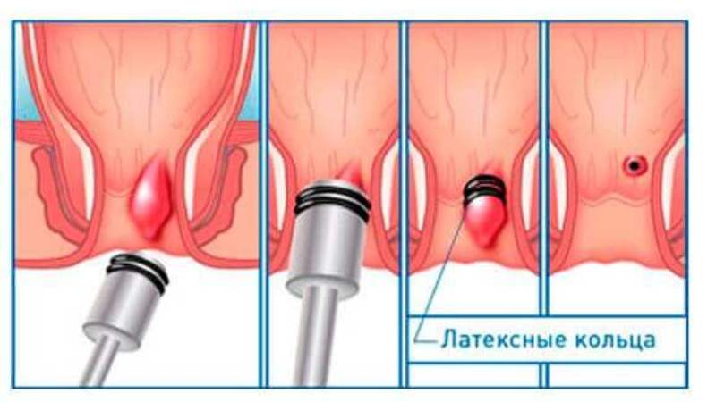 профилактика геморроя у беременных