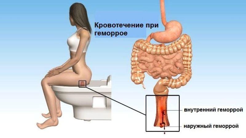 симптомы геморроя у женщин при беременности