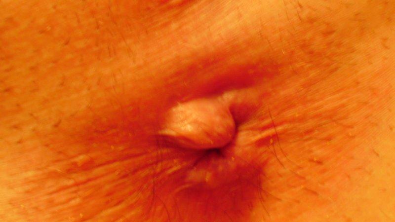 геморрой у подростков причины и лечение