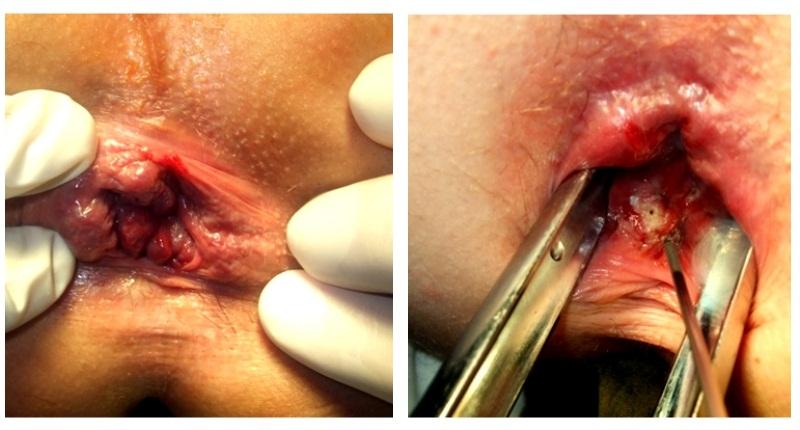 как выглядит геморроидальный узел