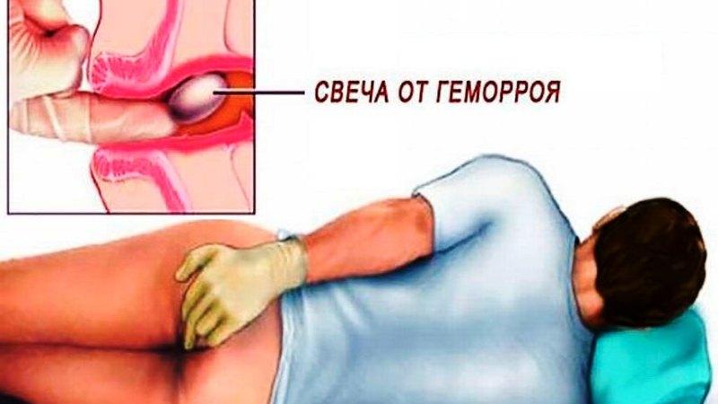 как правильно вводить свечи