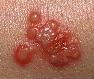 Что такое герпес и как он относится к прямой кишке