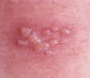 Что такое герпес и как он относится к прямой кишке