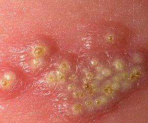 Что такое герпес и как он относится к прямой кишке