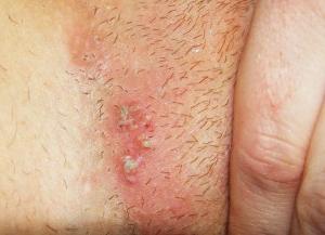 Что такое герпес и как он относится к прямой кишке