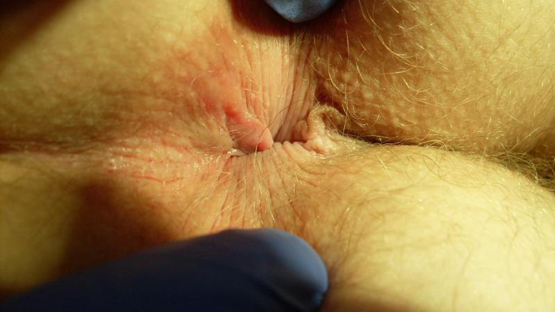 как выглядит геморрой