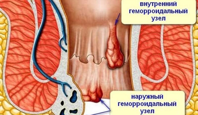 упражнения кегеля для мужчин при геморрое