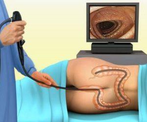 Что такое эндометриоз прямой кишки и его симптомы