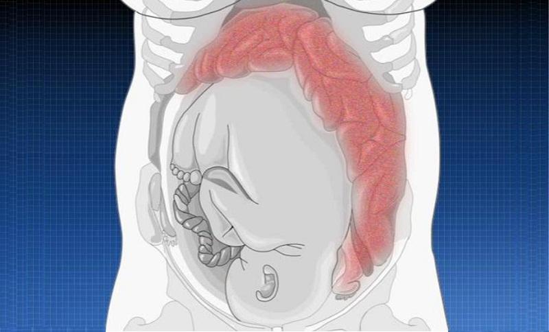 как избавиться от запоров в домашних условиях во время беременности как беременной избавиться от запоров