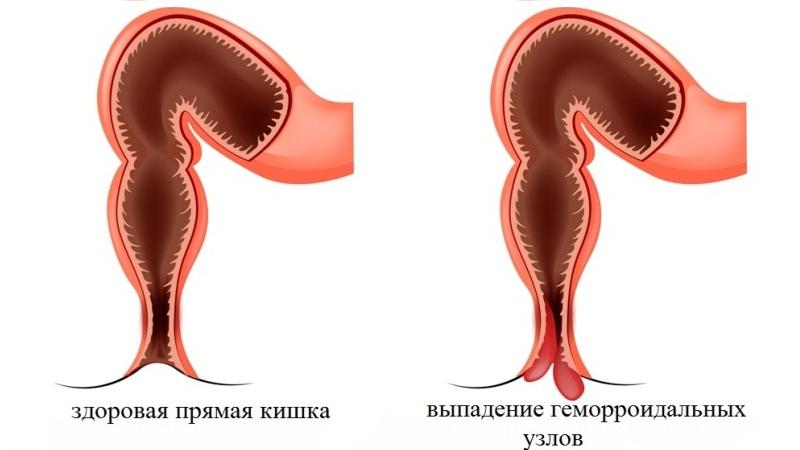 как избавиться от геморроя в домашних условиях навсегда
