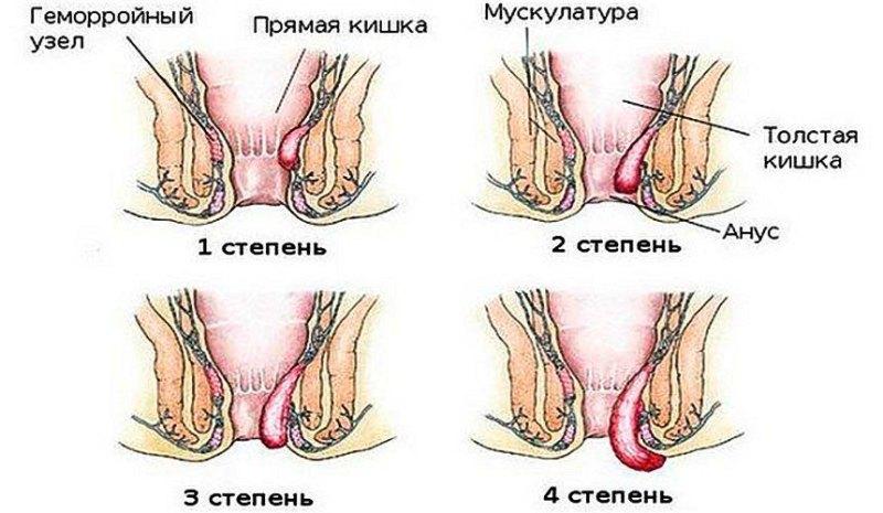 как избавиться от шишки геморроя