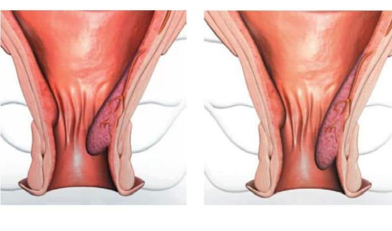 как избавиться от геморроидальной шишки