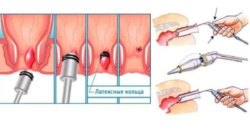 как народными средствами избавиться от геморроя