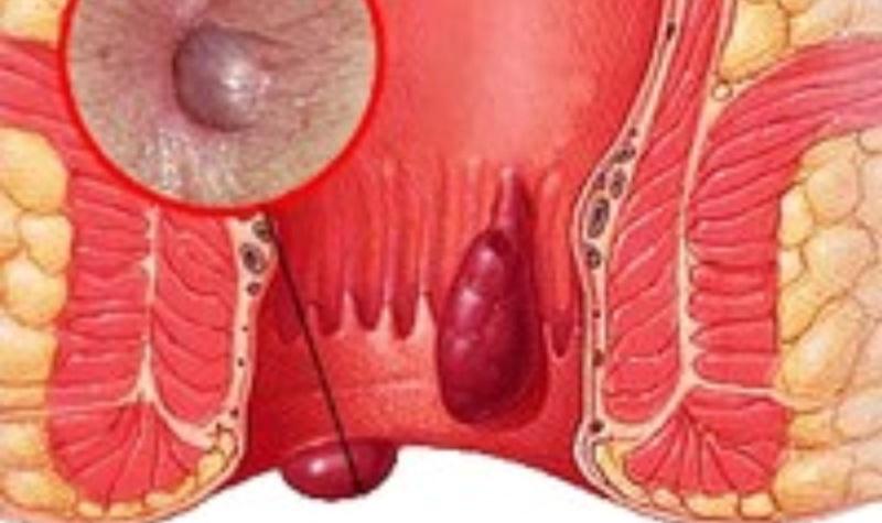 как лазером удаляют геморрой