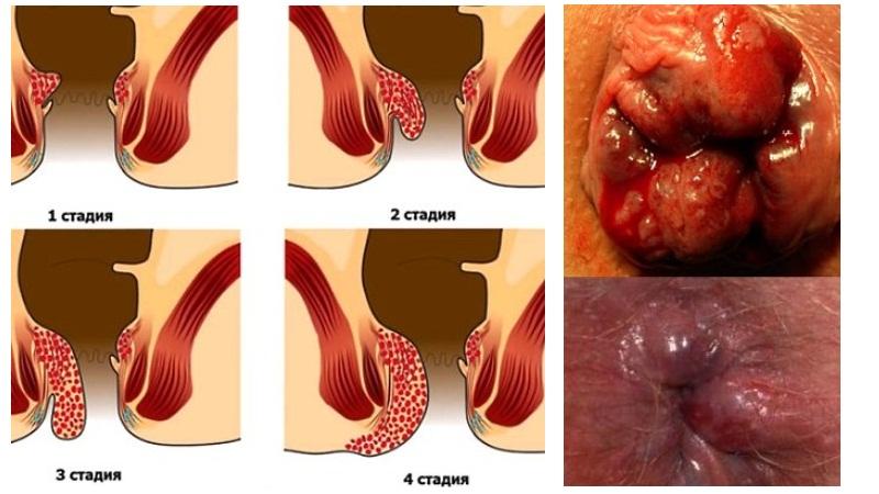 как лечат геморрой
