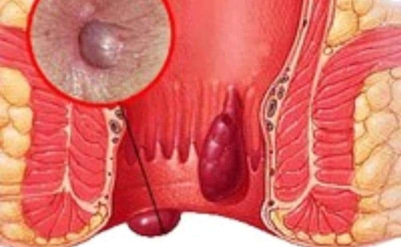 как лечить геморрой в домашних условиях у мужчин быстро