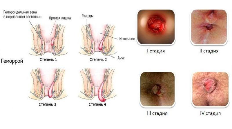 лечение геморроя в домашних условиях народными средствами у мужчин