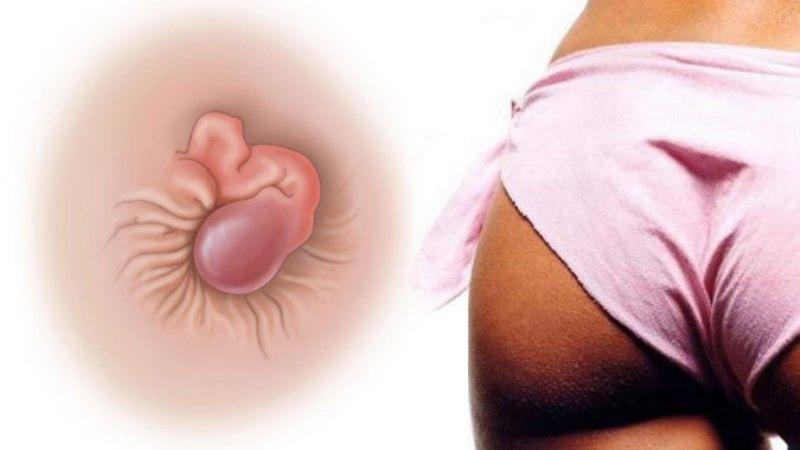 как определить геморрой или нет