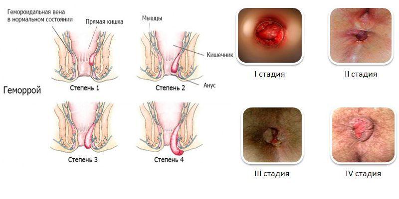 как понять что у тебя геморрой фото