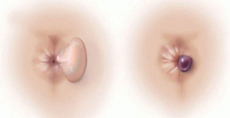 как диагностируют геморрой